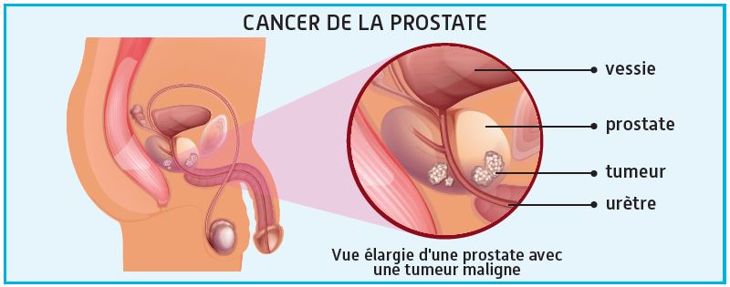 La prostate en 5 questions - CCMO Mutuelle