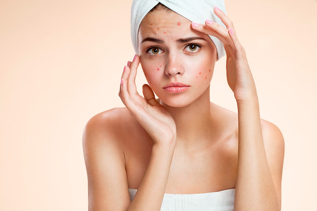 Femme en serviette de bain avec boutons sur le visage