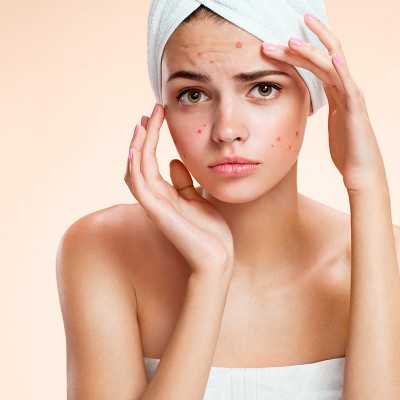 Femme en serviette de bain avec boutons sur le visage